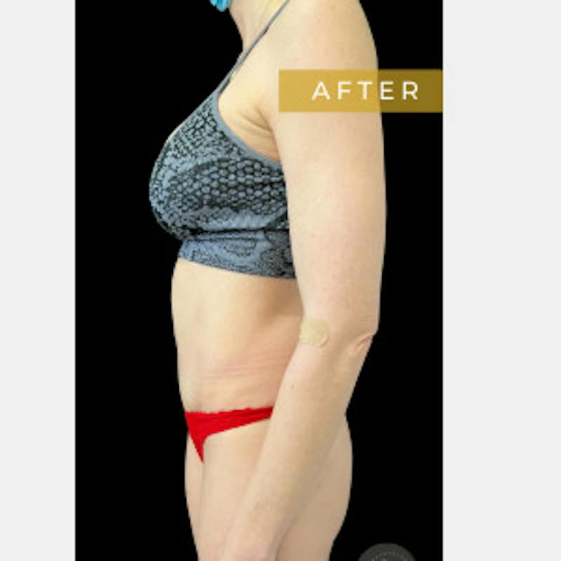 Mommy Makeover Before & After Gallery - Patient 142841 - Image 4