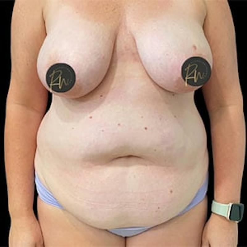 Mommy Makeover Before & After Gallery - Patient 452085 - Image 1