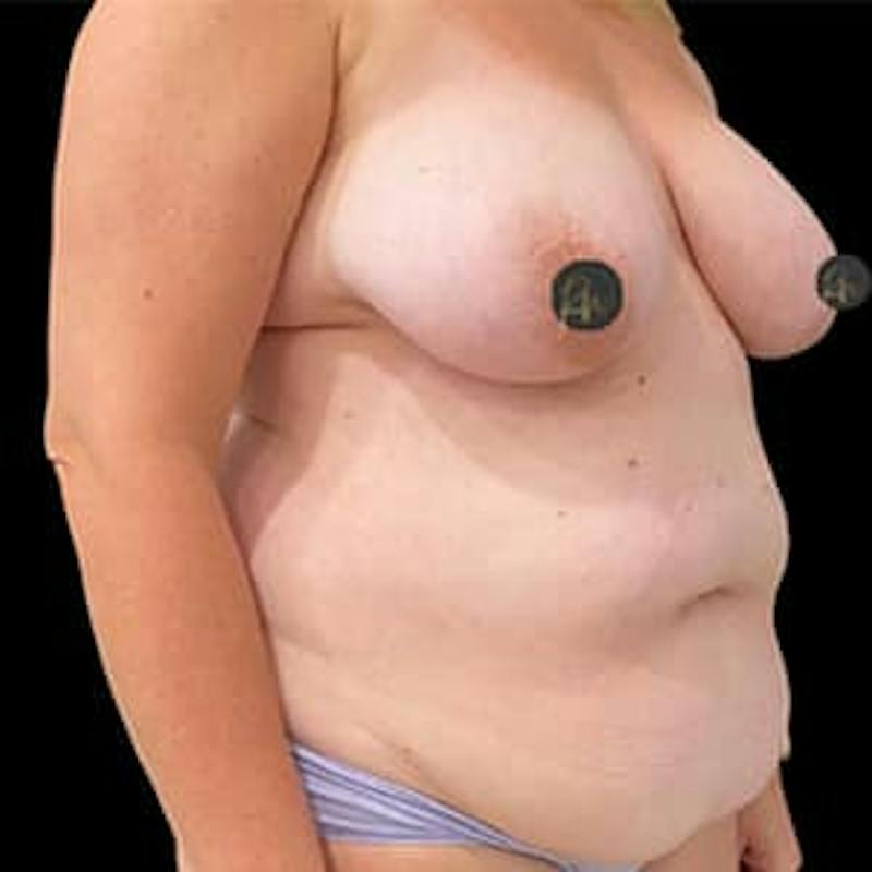 Mommy Makeover Before & After Gallery - Patient 452085 - Image 3