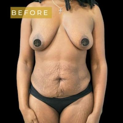 Mommy Makeover Before & After Gallery - Patient 231082 - Image 1