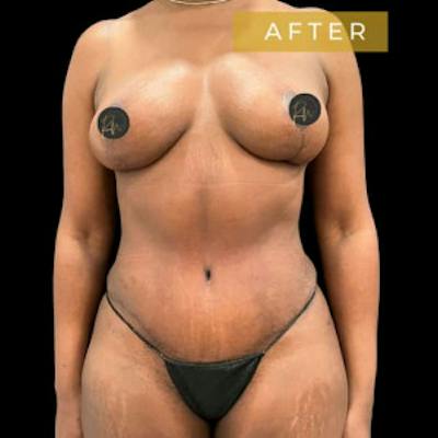 Mommy Makeover Before & After Gallery - Patient 231082 - Image 2