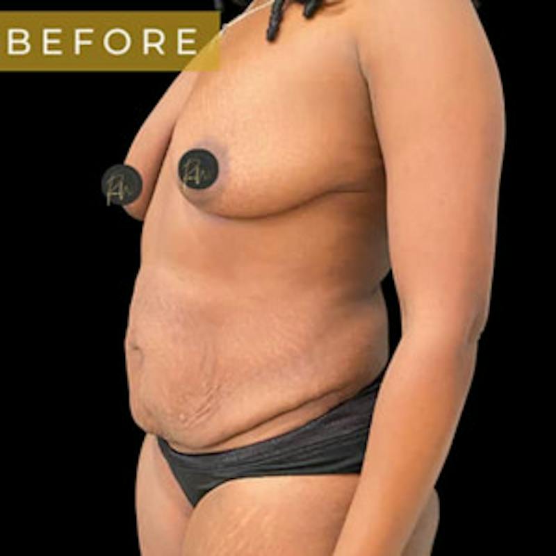 Mommy Makeover Before & After Gallery - Patient 231082 - Image 3