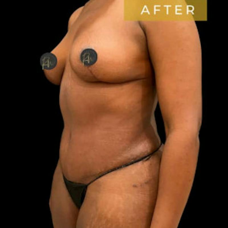 Mommy Makeover Before & After Gallery - Patient 231082 - Image 4