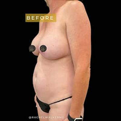 Mommy Makeover Before & After Gallery - Patient 216088 - Image 1