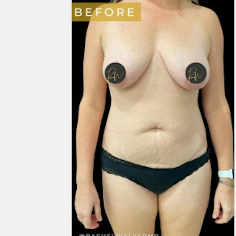 Mommy Makeover Before & After Gallery - Patient 386164 - Image 3