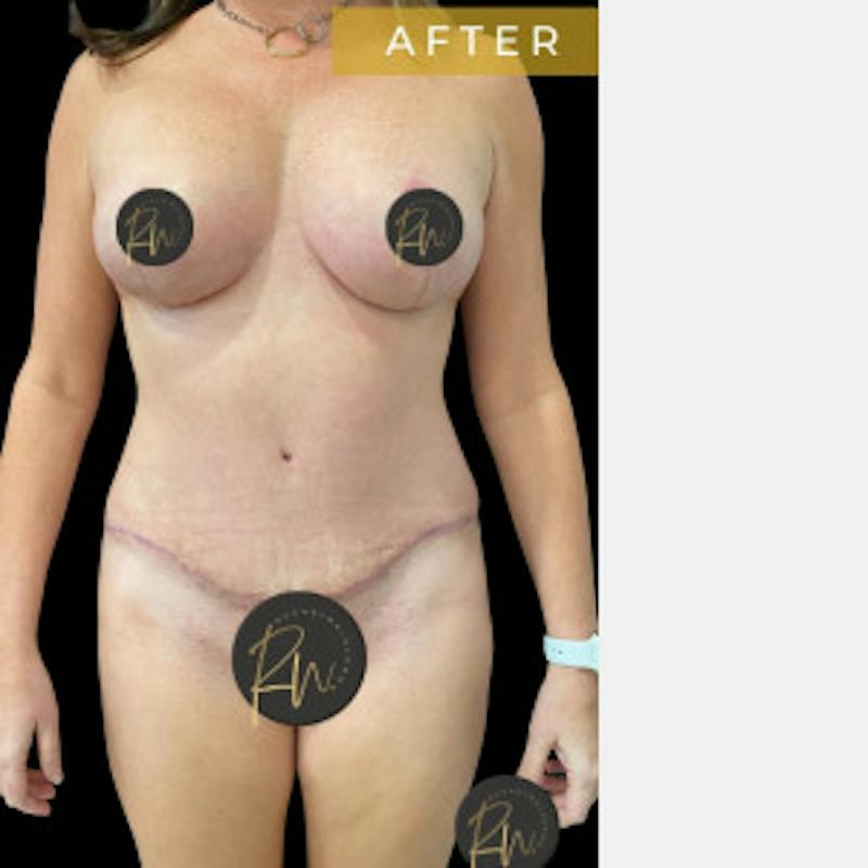 Mommy Makeover Before & After Gallery - Patient 386164 - Image 4