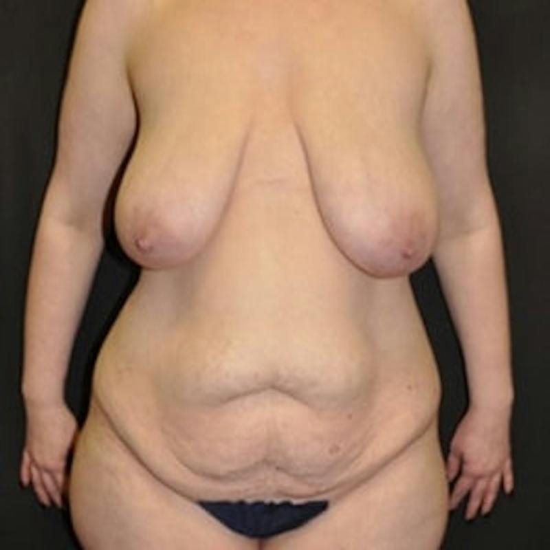Mommy Makeover Before & After Gallery - Patient 422111 - Image 1