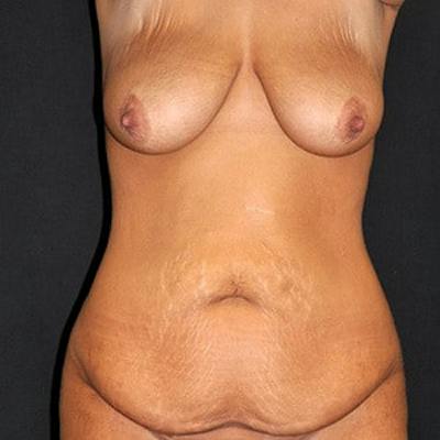 Mommy Makeover Before & After Gallery - Patient 138798 - Image 1