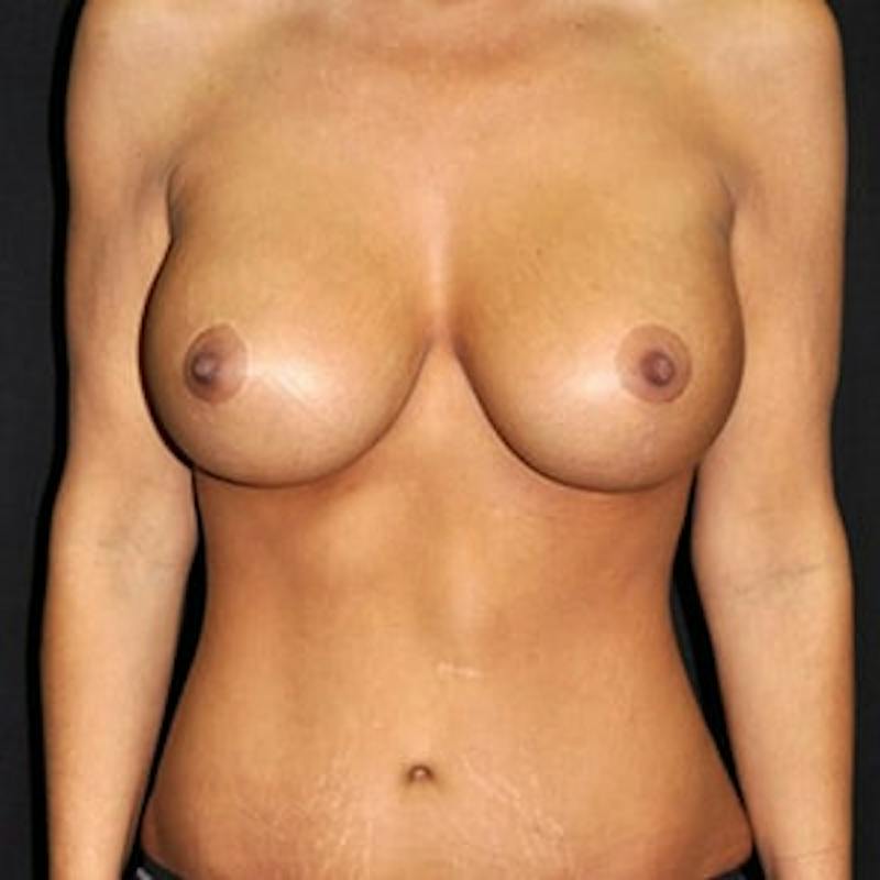 Mommy Makeover Before & After Gallery - Patient 410488 - Image 2