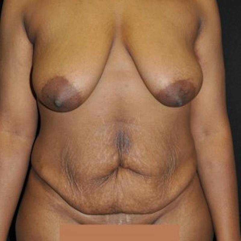 Mommy Makeover Before & After Gallery - Patient 180881 - Image 1