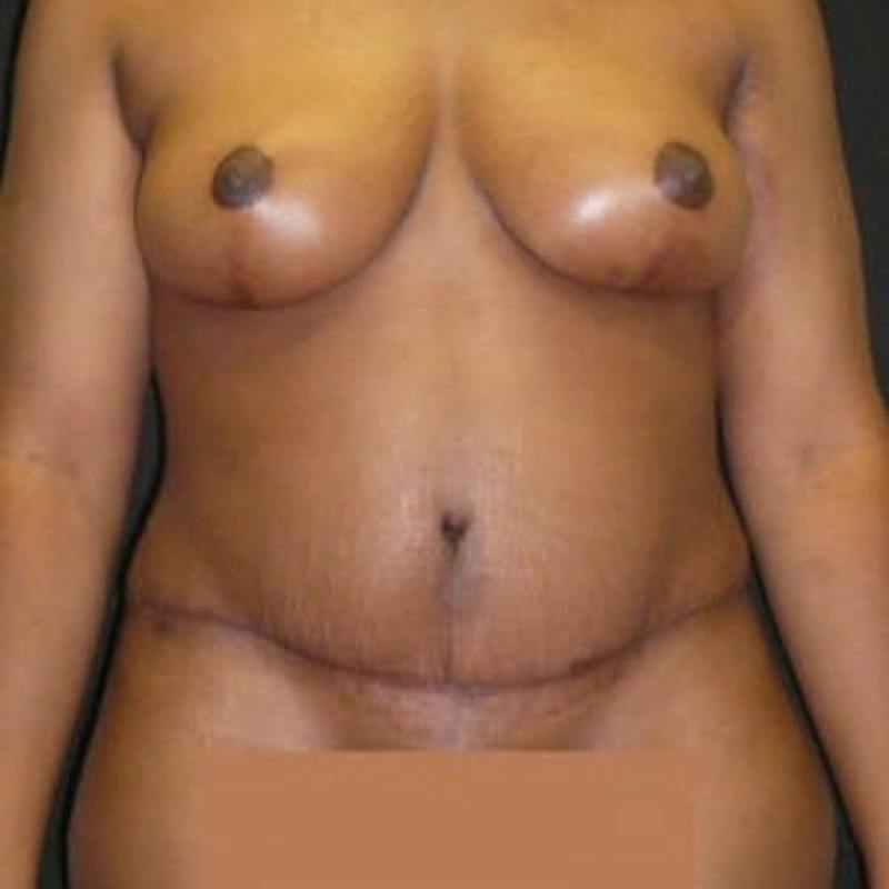 Mommy Makeover Before & After Gallery - Patient 180881 - Image 2