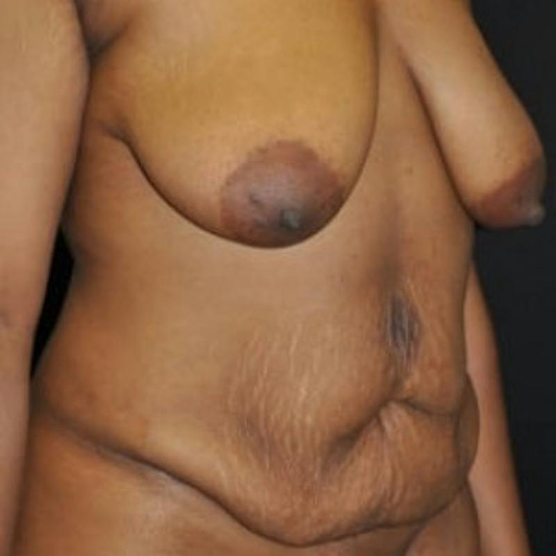 Mommy Makeover Before & After Gallery - Patient 180881 - Image 3