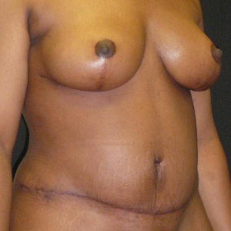 Mommy Makeover Before & After Gallery - Patient 180881 - Image 4
