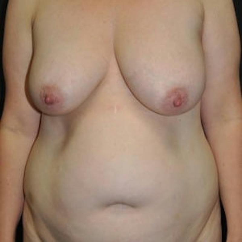 Mommy Makeover Before & After Gallery - Patient 124722 - Image 1