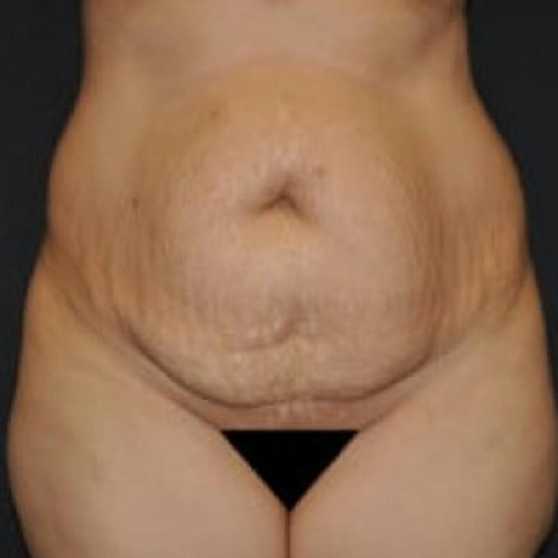 Mommy Makeover Before & After Gallery - Patient 100710 - Image 1