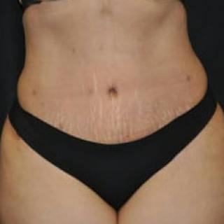 Mommy Makeover Before & After Gallery - Patient 100710 - Image 2