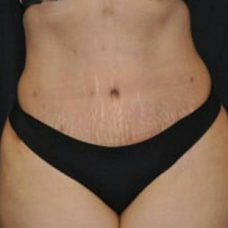 Mommy Makeover Before & After Gallery - Patient 100710 - Image 2