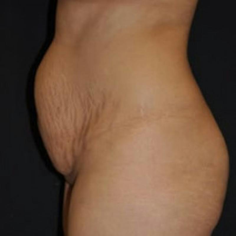 Mommy Makeover Before & After Gallery - Patient 100710 - Image 3