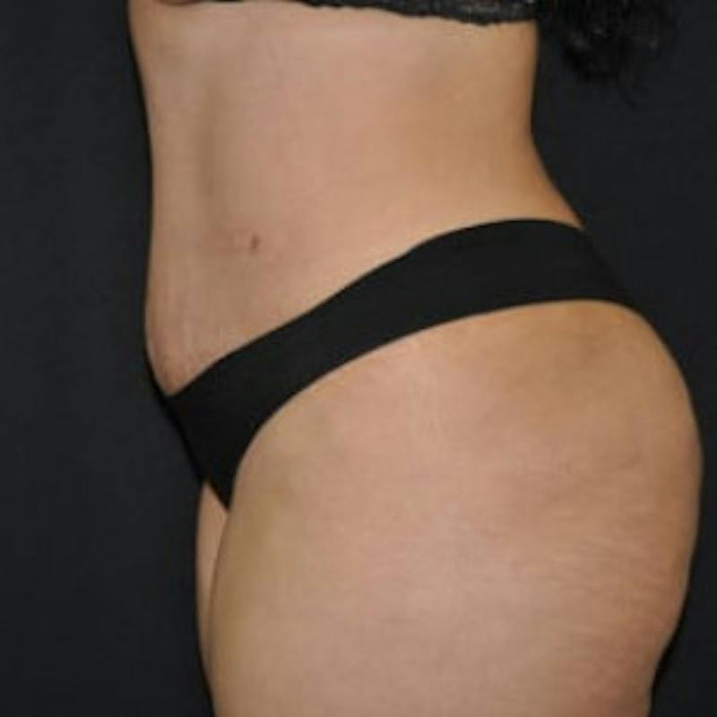 Mommy Makeover Before & After Gallery - Patient 100710 - Image 4