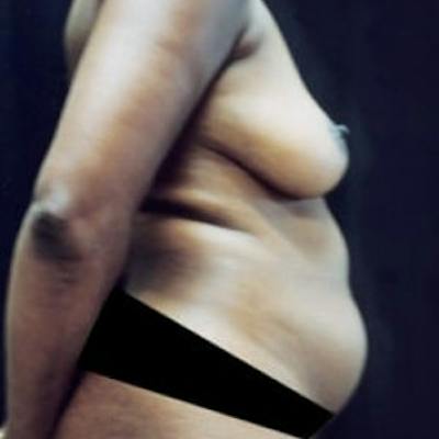 Mommy Makeover Before & After Gallery - Patient 370545 - Image 1