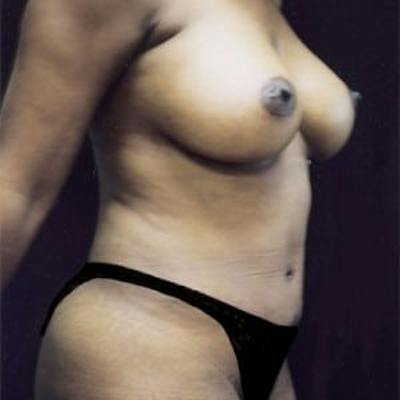 Mommy Makeover Before & After Gallery - Patient 370545 - Image 2