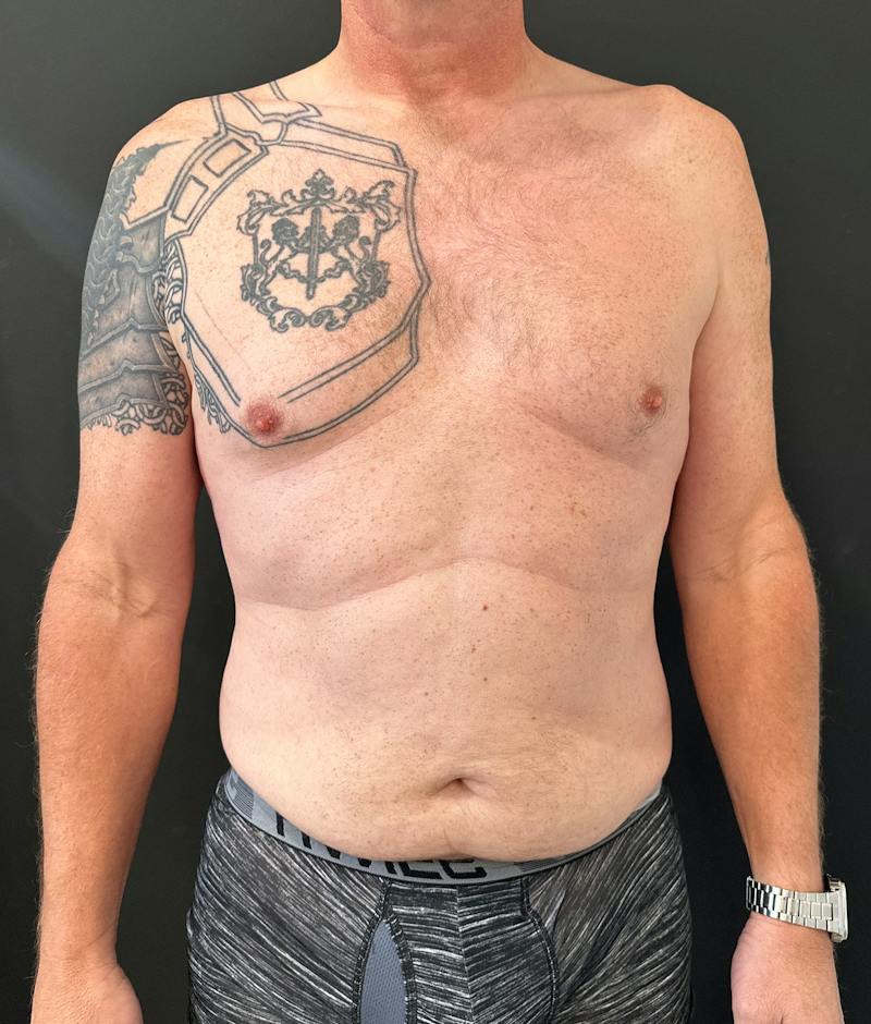 Abdominoplasty (Tummy Tuck) Before & After Gallery - Patient 409650 - Image 1