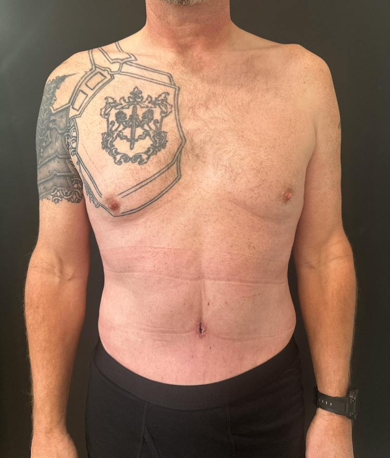 Abdominoplasty (Tummy Tuck) Before & After Gallery - Patient 409650 - Image 2