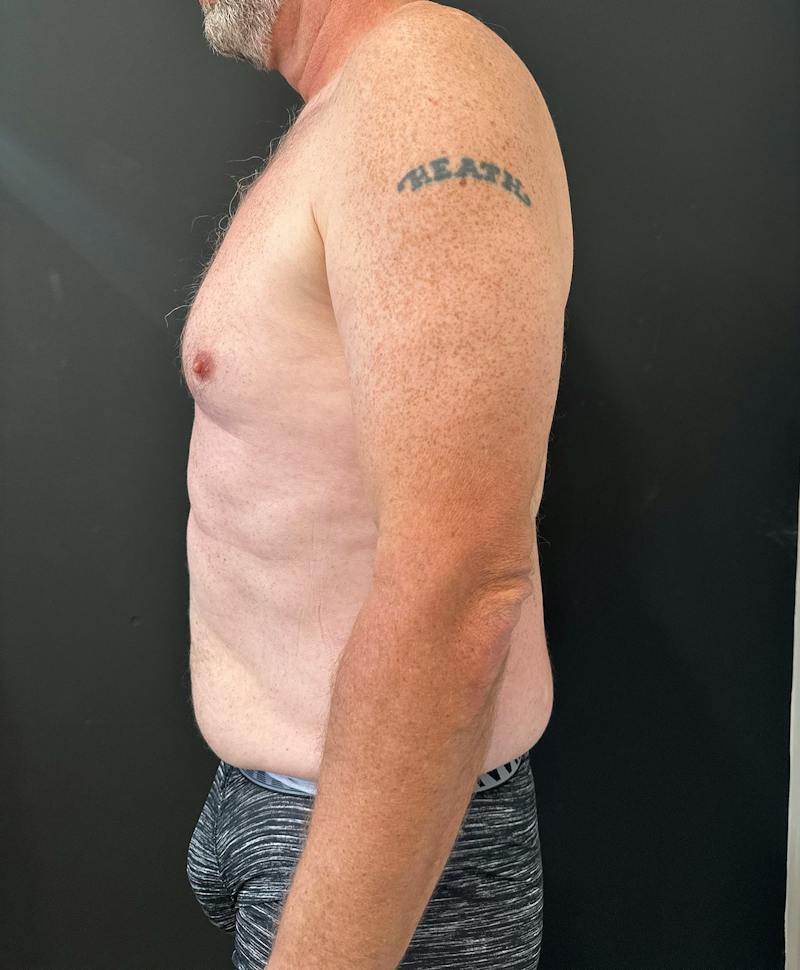 Abdominoplasty (Tummy Tuck) Before & After Gallery - Patient 409650 - Image 3