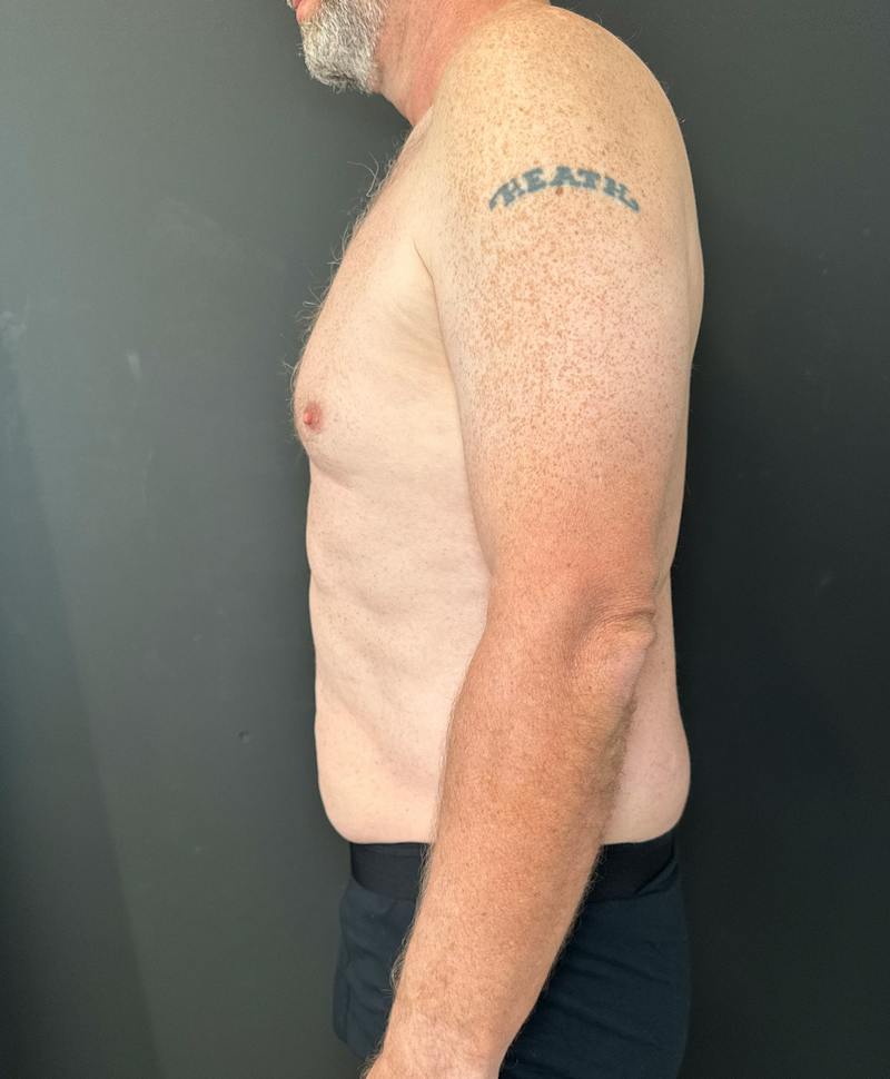 Abdominoplasty (Tummy Tuck) Before & After Gallery - Patient 409650 - Image 4