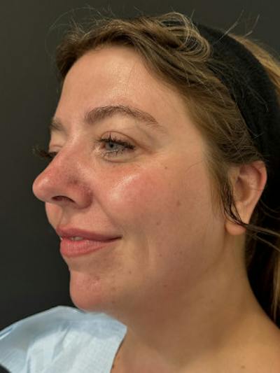 SAFElipo Before & After Gallery - Patient 158988 - Image 1
