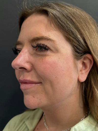 SAFElipo Before & After Gallery - Patient 158988 - Image 2