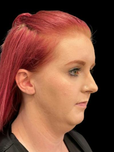 SAFElipo Before & After Gallery - Patient 175622 - Image 1