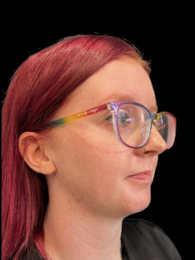 SAFElipo Before & After Gallery - Patient 175622 - Image 2