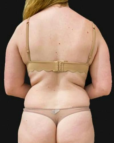 SAFElipo Before & After Gallery - Patient 179581 - Image 1