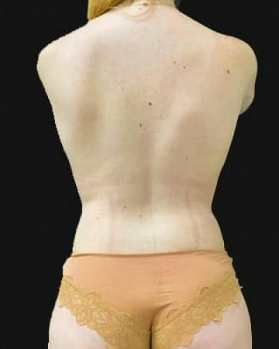 SAFElipo Before & After Gallery - Patient 179581 - Image 2