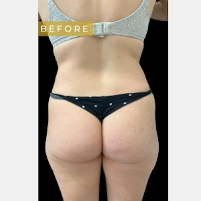 SAFElipo Before & After Gallery - Patient 267968 - Image 1