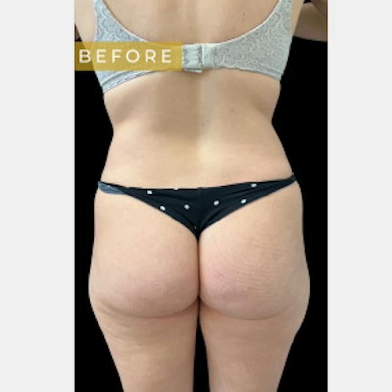 SAFElipo Before & After Gallery - Patient 267968 - Image 1