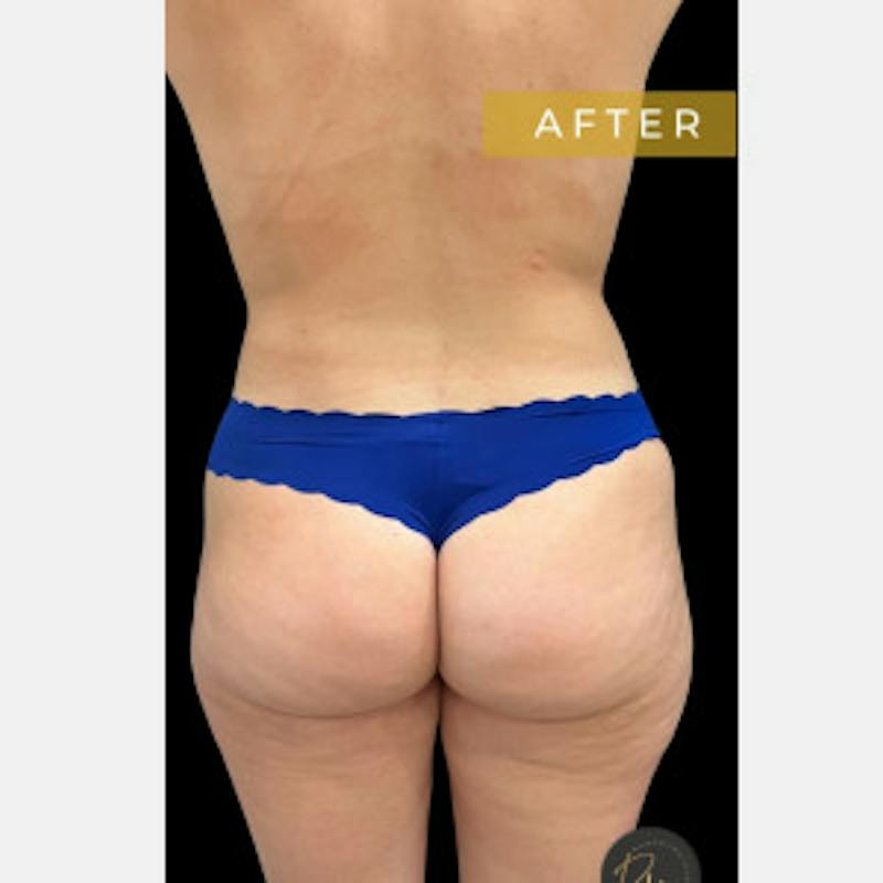 SAFElipo Before & After Gallery - Patient 267968 - Image 2