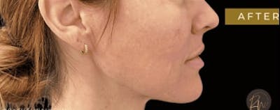 SAFElipo Before & After Gallery - Patient 311023 - Image 2