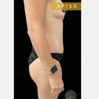 Abdominoplasty (Tummy Tuck) Before & After Gallery - Patient 369710 - Image 2