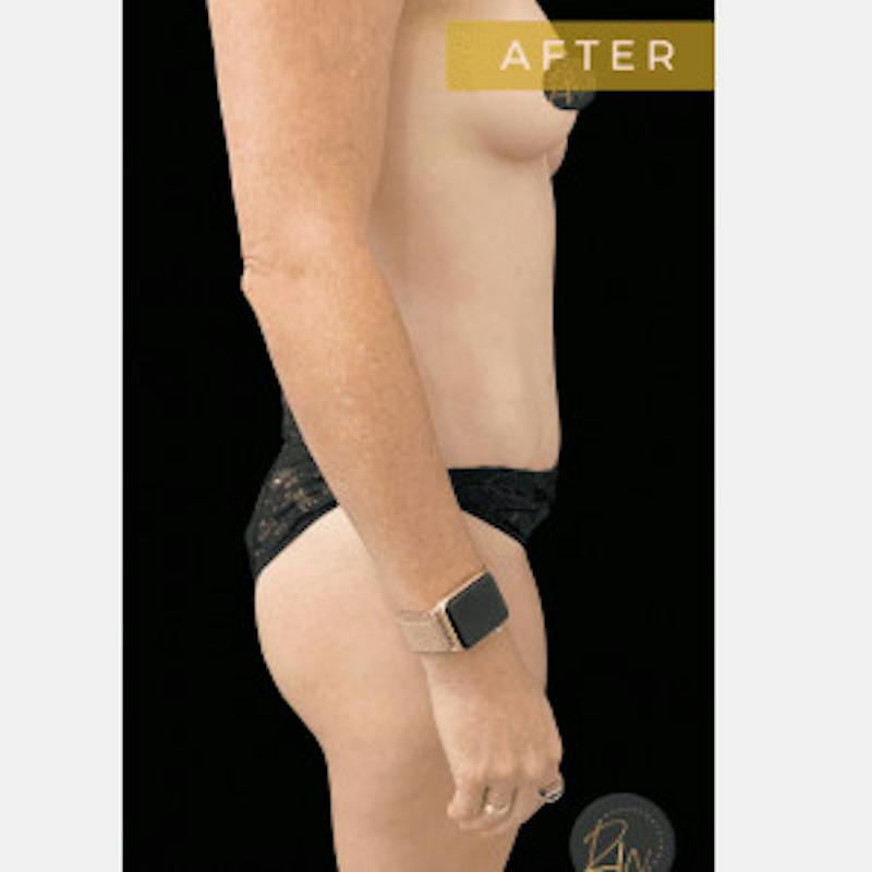 Abdominoplasty (Tummy Tuck) Before & After Gallery - Patient 369710 - Image 2