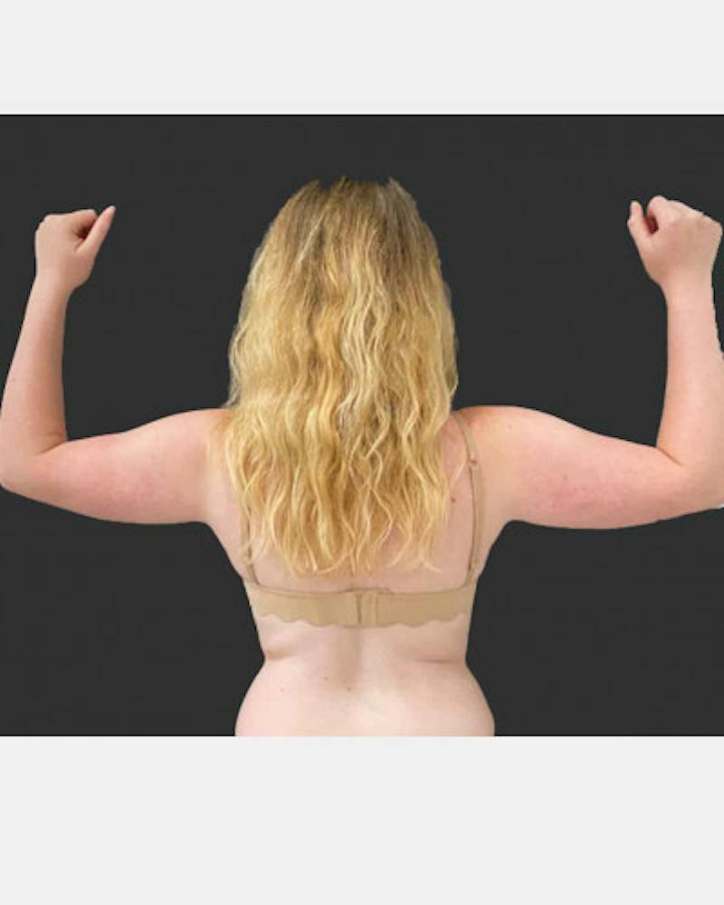 SAFElipo Before & After Gallery - Patient 348037 - Image 1