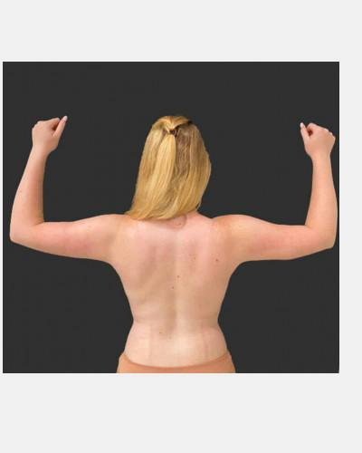 SAFElipo Before & After Gallery - Patient 348037 - Image 2