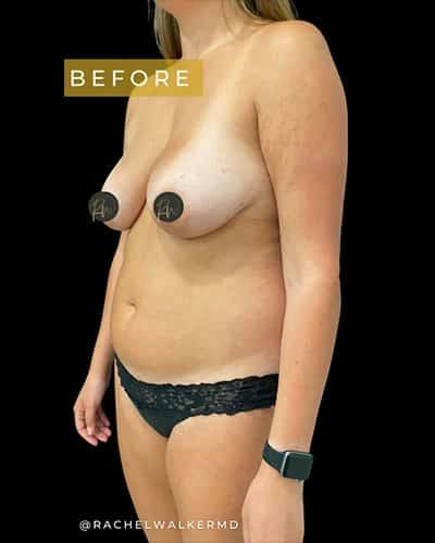 SAFElipo Before & After Gallery - Patient 277781 - Image 1