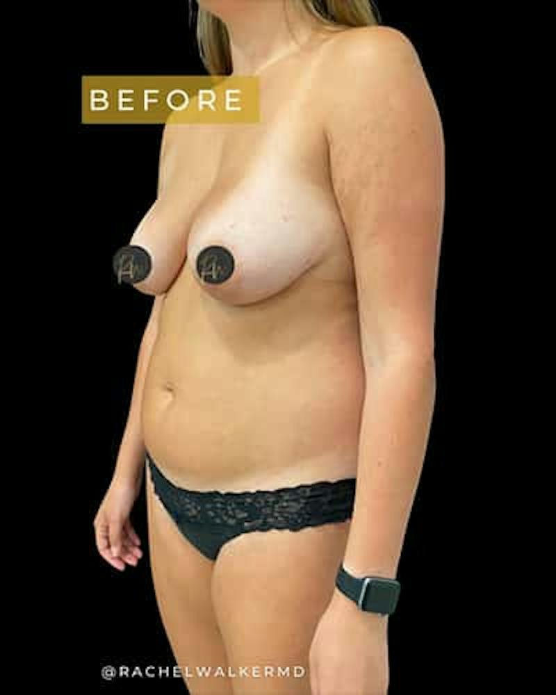 SAFElipo Before & After Gallery - Patient 277781 - Image 1