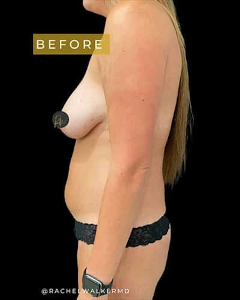 SAFElipo Before & After Gallery - Patient 277781 - Image 3