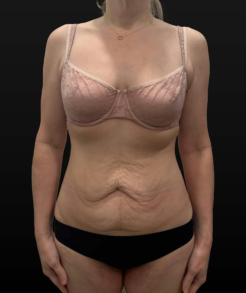 Abdominoplasty (Tummy Tuck) Before & After Gallery - Patient 631139 - Image 1