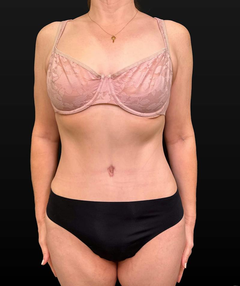Abdominoplasty (Tummy Tuck) Before & After Gallery - Patient 631139 - Image 2