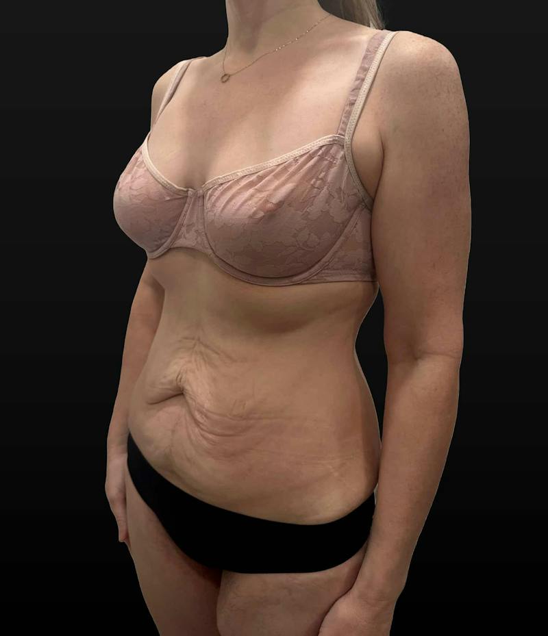 Abdominoplasty (Tummy Tuck) Before & After Gallery - Patient 631139 - Image 3