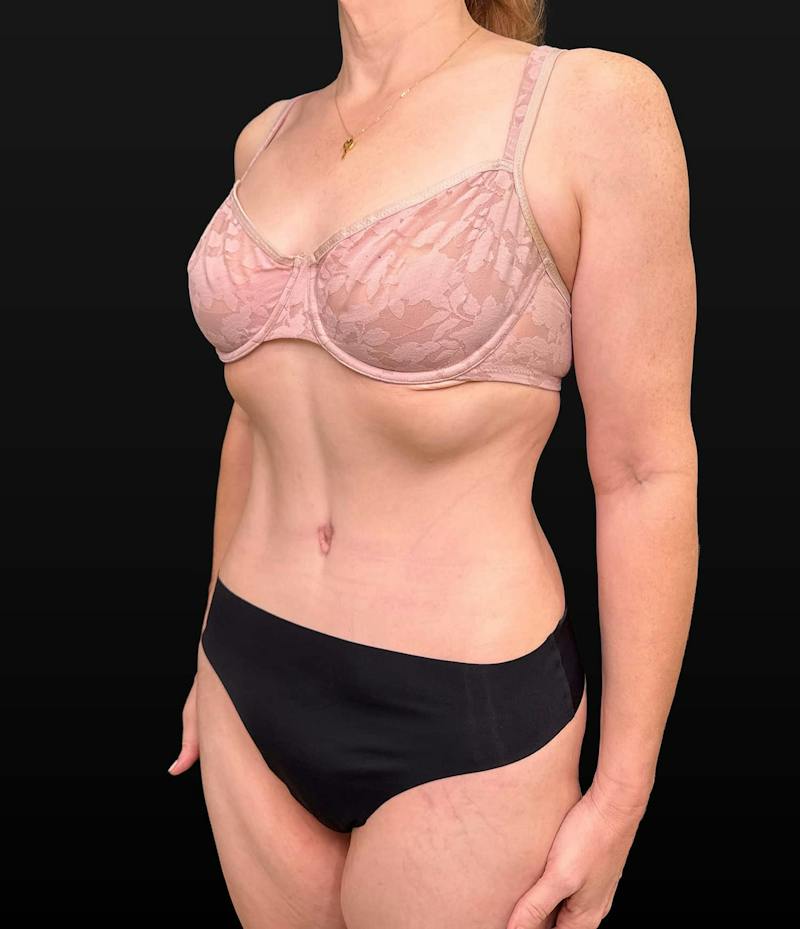 Abdominoplasty (Tummy Tuck) Before & After Gallery - Patient 631139 - Image 4